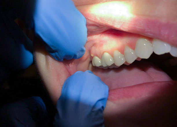 Best Urgent Tooth Repair  in Wanakah, NY